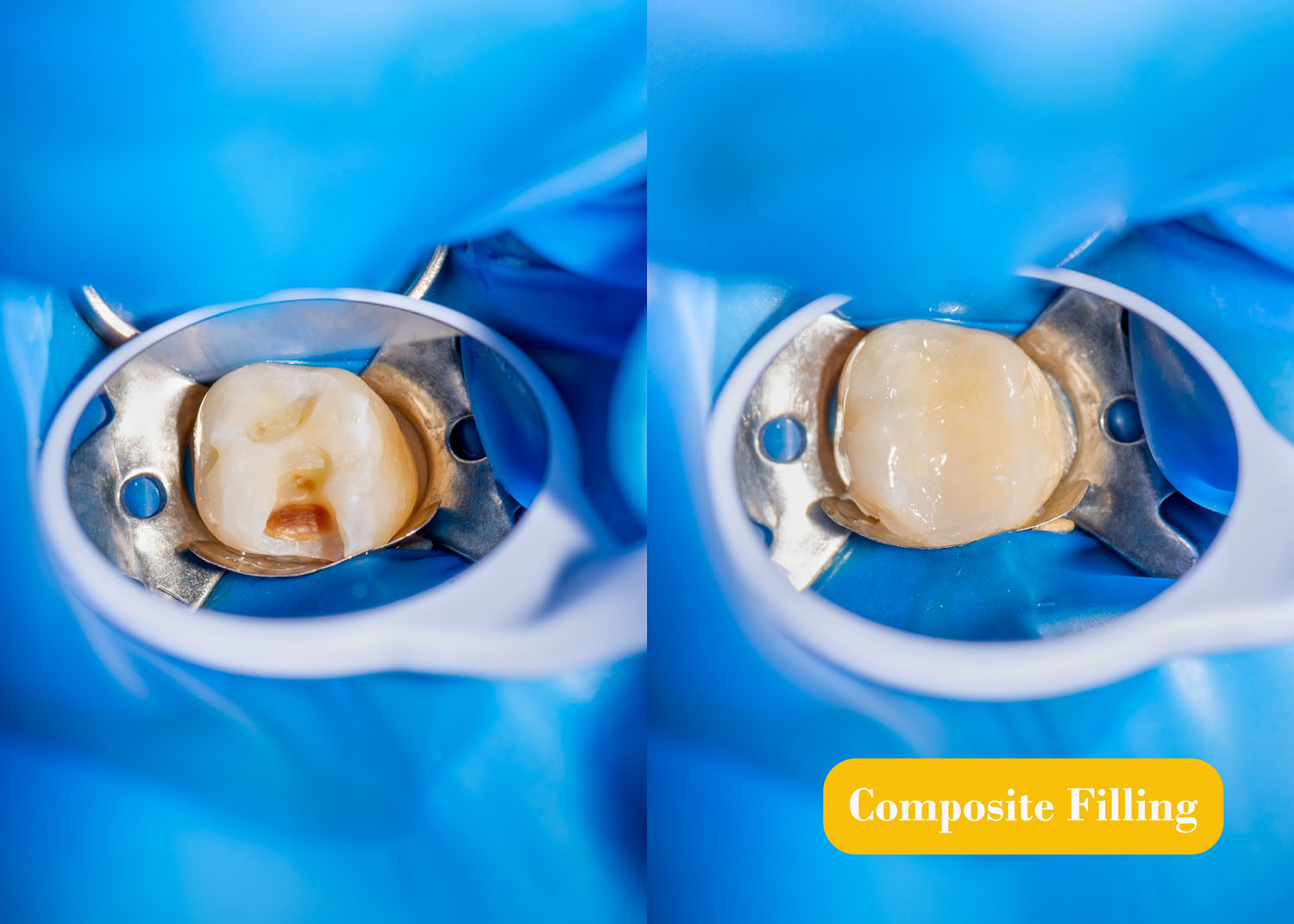 Composite Fillings Lighthouse Dental Centre Langley